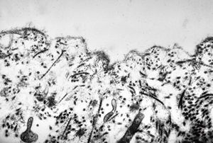 M, 1y. | epidermolysis bullosa … junctional type M, 1y. | epidermolysis bullosa … junctional type